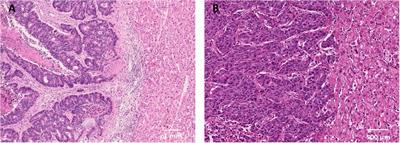 Histopathological growth pattern of liver metastases as an independent marker of metastatic behavior in different primary cancers